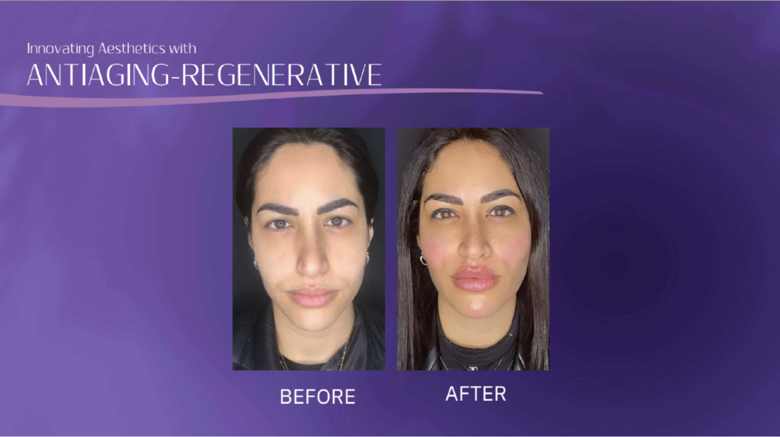 Hyalure Launches World’s First Dermal Filler With Anti-Ageing Properties